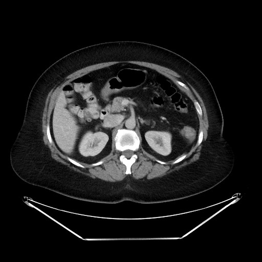 File:Colonic intussusception due to adenocarcinoma (Radiopaedia 86828-102987 A 54).jpg