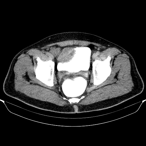 File:Colonic lipoma with colo-colic intussusception (Radiopaedia 58944-66200 Axial C+ rectal 66).jpg