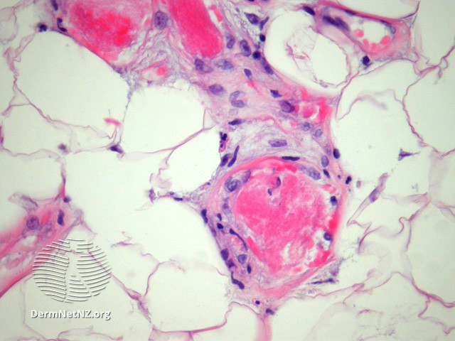 File:Figure 2 (DermNet NZ pathology-e-angiolipoma-fig-2).jpg