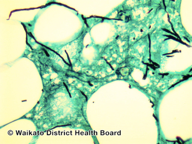 File:Figure 6 (DermNet NZ pathology-w-aspergillus-gms-fig-6).jpg