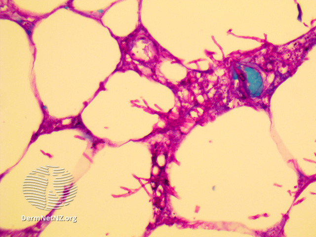 File:Histopathology (DermNet NZ fungal-aspergillus-02).jpg