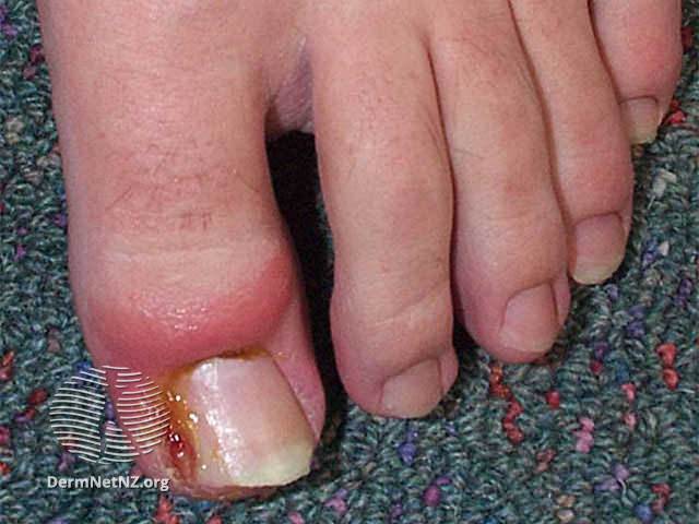 File:In-growing nail with granuloma formation aggravated by an oral retinoid (DermNet NZ doctors-principles-images-ingrown).jpg