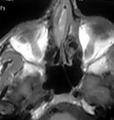 File:Nasal septum hematoma (Radiopaedia 6778-7968 Axial T1 1).jpg