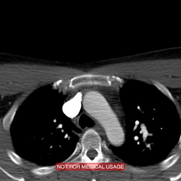 File:Nasopharyngeal carcinoma recurrence - skull base destruction (Radiopaedia 29107-29491 A 44).jpg