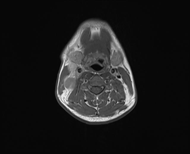 File:Nasopharyngeal carcinoma with perineural spread (Radiopaedia 55030-61380 Axial T1 14).jpg