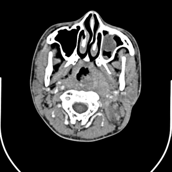 Nasopharyngeal carcinoma with skull base invasion (Radiopaedia 53415-59705 A 64).jpg