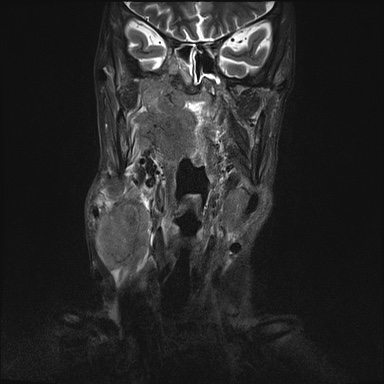 Nasopharyngeal carcinoma with skull base invasion (Radiopaedia 59258-66600 Coronal T2 fat sat 21).jpg