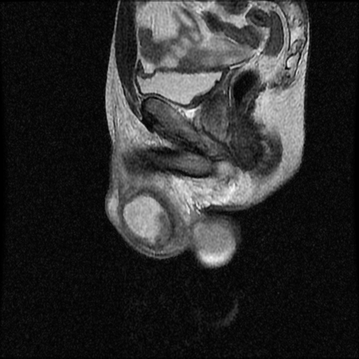 File:Necrotizing epididymo-orchitis with intra-testicular abscess (Radiopaedia 29397-29860 Sagittal T2 12).jpg