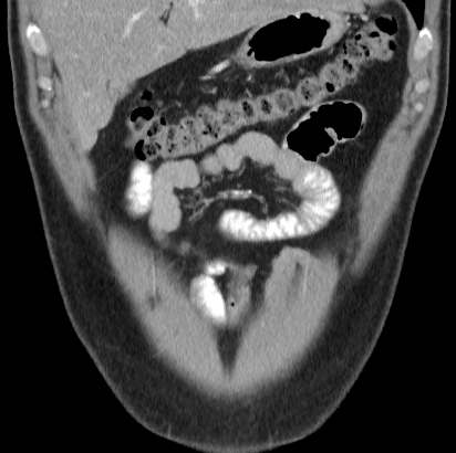 File:Necrotizing pancreatitis with acute necrotic collection (Radiopaedia 14470-14417 C 3).jpg