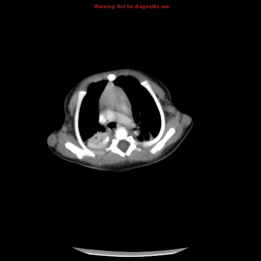 File:Neonatal neuroblastoma (Radiopaedia 9564-10223 A 5).jpg