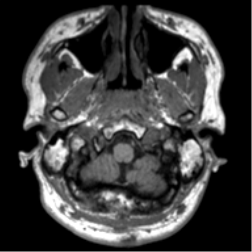 File:Neurofibromatosis type 2 (Radiopaedia 44936-48838 Axial T1 8).png