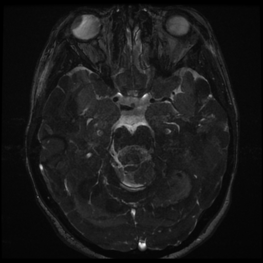 File:Neurofibromatosis type 2 - bilateral acoustic neuromata (Radiopaedia 40060-42566 Axial FIESTA 80).png