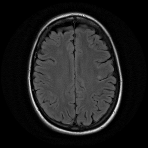 File:Neurofibromatosis type 2 - bilateral acoustic neuromata (Radiopaedia 40060-42566 Axial FLAIR 15).png