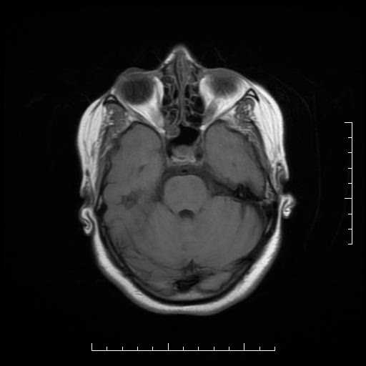 File:Neuroglial cyst of brainstem (Radiopaedia 29134-29526 Axial T1 6).jpg