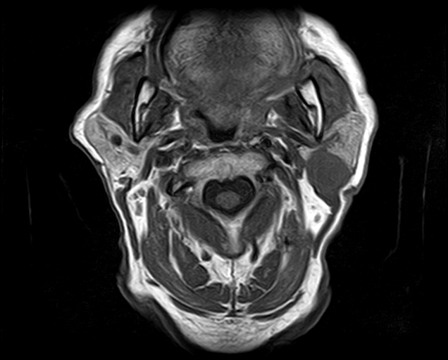 File:Non-Hodgkin lymphoma - parotid gland (Radiopaedia 71531-81890 Axial T1 12).jpg