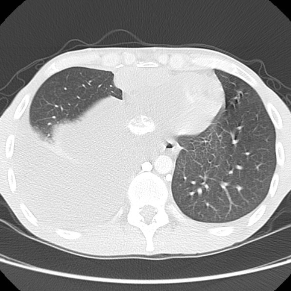 File:Non-Hodgkin lymphoma involving lung (Radiopaedia 29094-29470 Axial lung window 53).jpg