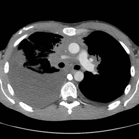File:Non-Hodgkin lymphoma involving lung (Radiopaedia 29094-29470 B 30).jpg