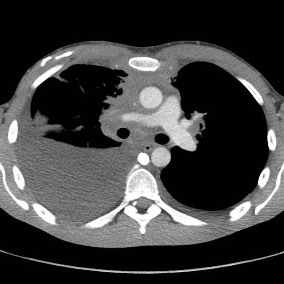 File:Non-Hodgkin lymphoma involving lung (Radiopaedia 29094-29470 B 31).jpg