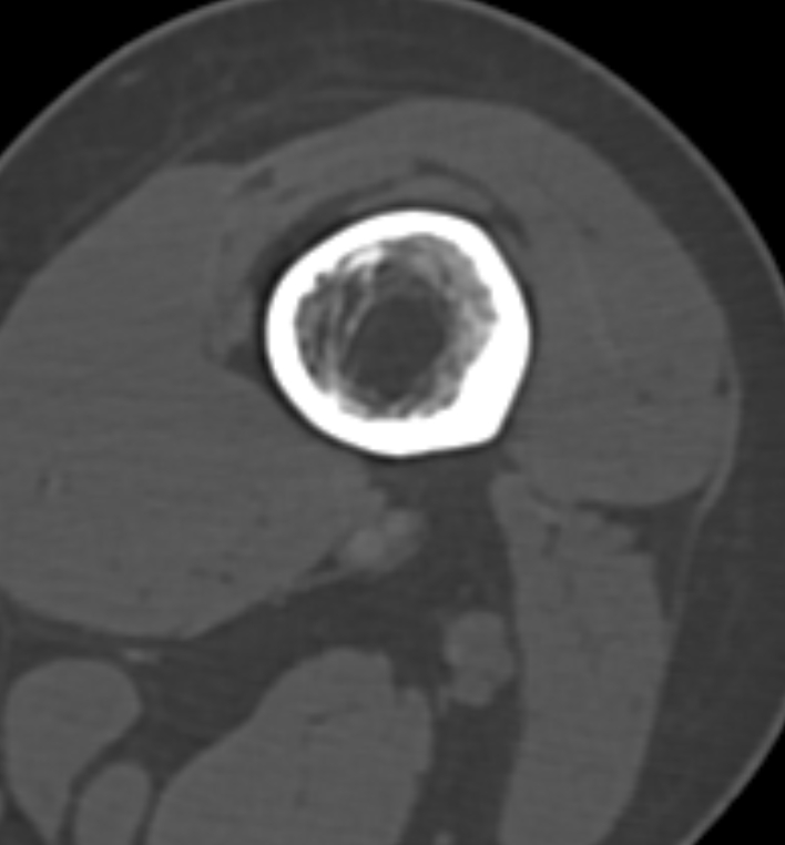 Non-ossifying fibroma - femur (Radiopaedia 82786-97042 Axial bone window 34).jpg