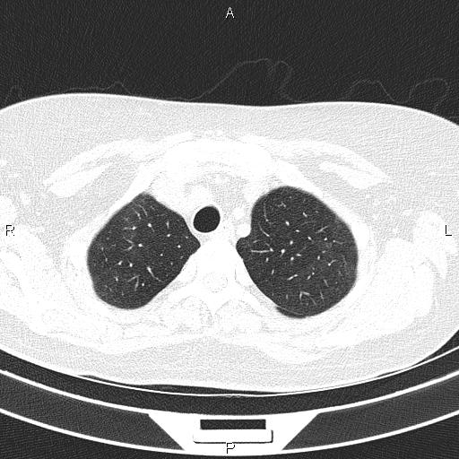 Non-specific interstitial pneumonia (Radiopaedia 83185-97567 Axial lung window 15).jpg