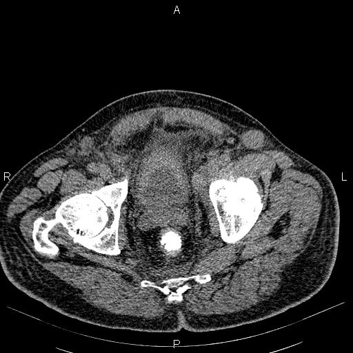 File:Non Hodgkin lymphoma in a patient with ankylosing spondylitis (Radiopaedia 84323-99621 Axial non-contrast 58).jpg