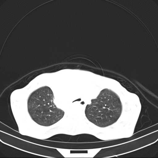 File:Non hodgkin lymphoma of the mediastinum (Radiopaedia 20814-20729 Axial lung window 13).jpg