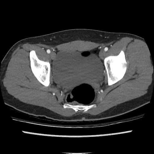 File:Normal CT angiogram of pelvis (Radiopaedia 45390-49430 A 42).jpg