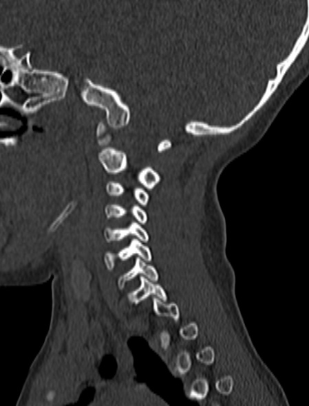 Normal CT cervical spine - pediatric (Radiopaedia 52549-58462 Sagittal bone window 151).jpg