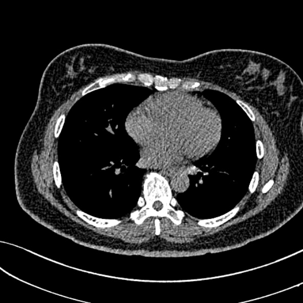 Normal CT chest- adult female (Radiopaedia 52522-58428 Axial non-contrast 77).jpg