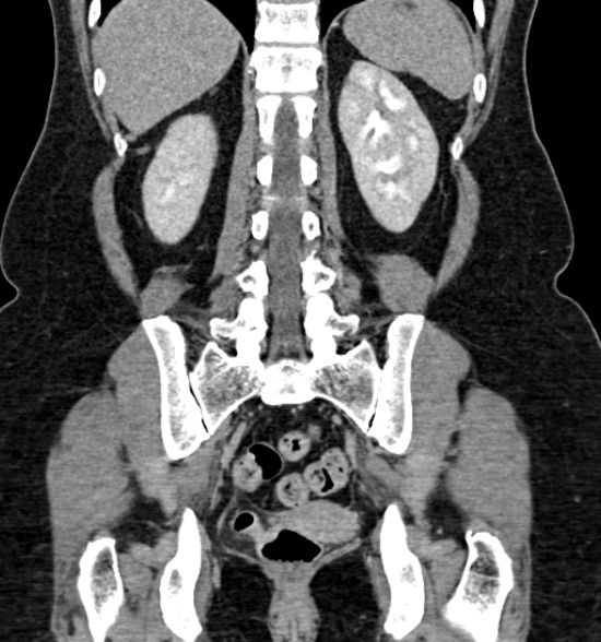 Normal CT intravenous urogram (Radiopaedia 39444-41759 A 326).jpg
