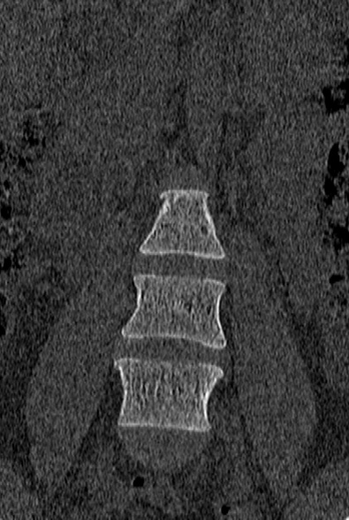 File:Normal CT lumbar spine (Radiopaedia 53981-60118 Coronal bone window 11).jpg