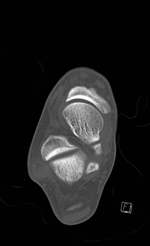 Normal CT of the ankle (Radiopaedia 47111-51658 Axial bone window 56).jpg