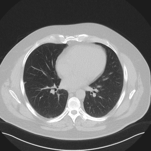 Normal HRCT (Radiopaedia 40797-43458 Axial lung window 34).png