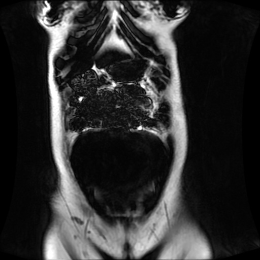 Normal MRI abdomen in pregnancy (Radiopaedia 88001-104541 N 36).jpg