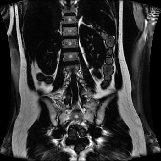 Normal MRI abdomen in pregnancy (Radiopaedia 88001-104541 N 97).jpg