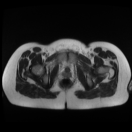 Normal MRI abdomen in pregnancy (Radiopaedia 88003-104546 Axial T2 49).jpg
