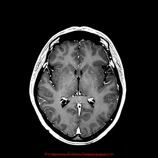 Normal adult brain MRI (non-enhanced and contrast-enhanced) (Radiopaedia 75262-86379 Axial T1 C+ 105).jpg