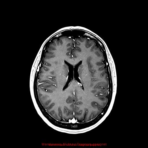 Normal adult brain MRI (non-enhanced and contrast-enhanced) (Radiopaedia 75262-86379 Axial T1 C+ 120).jpg