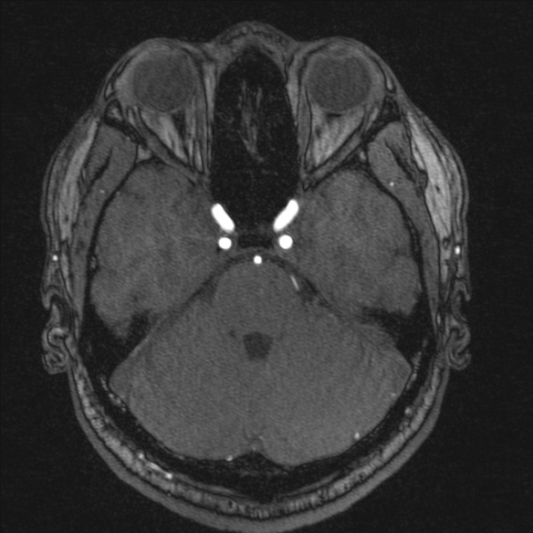 Normal brain MRI including MRA (Radiopaedia 48748-53763 Axial MRA 60).jpg