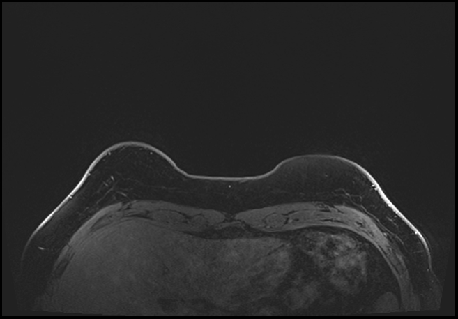Normal breast MRI - dense breasts (Radiopaedia 80454-93850 C 17).jpg