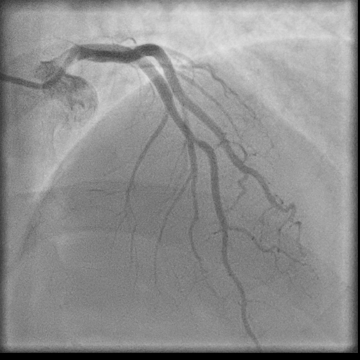 Normal coronary angiogram (DSA) (Radiopaedia 63081-71571 E 40).jpg