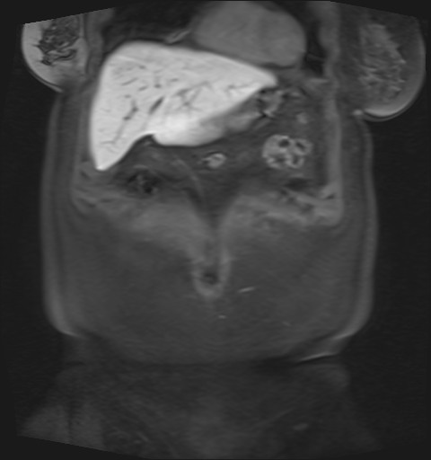 File:Normal hepatobiliary phase liver MRI (Radiopaedia 58968-66230 B 43).jpg