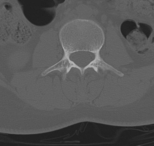 File:Normal lumbosacral CT (Radiopaedia 37923-39867 Axial bone window 52).png