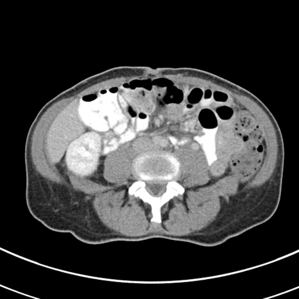 File:Normal multiphase CT liver (Radiopaedia 38026-39996 C 52).jpg