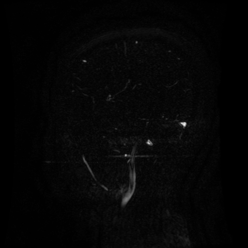 Normal noncontrast MR venography (Radiopaedia 87578-103957 A 133).jpg