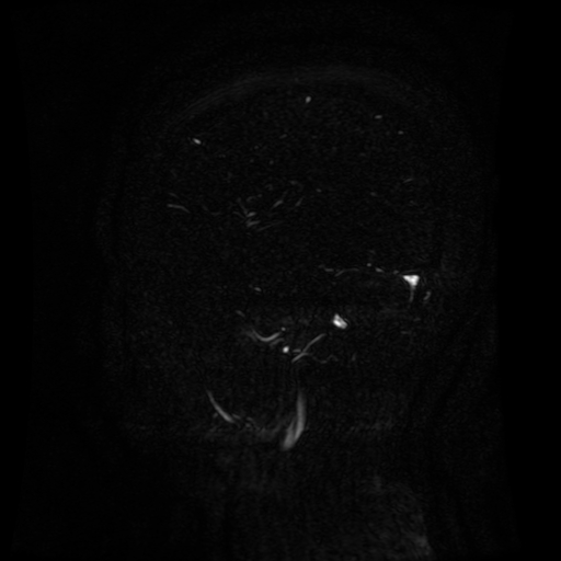 Normal noncontrast MR venography (Radiopaedia 87578-103957 A 136).jpg