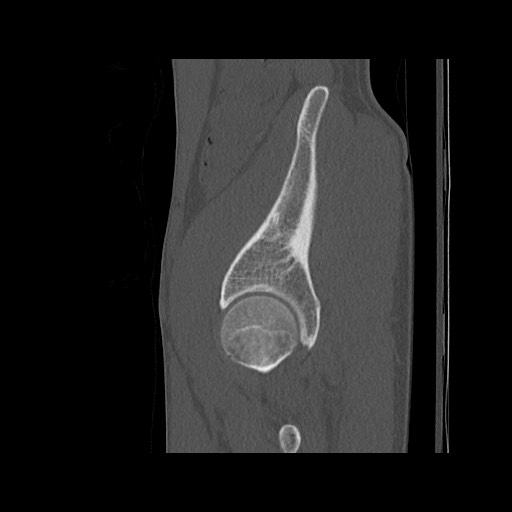 Normal pelvis (Radiopaedia 51473-57238 Sagittal bone window 115).jpg