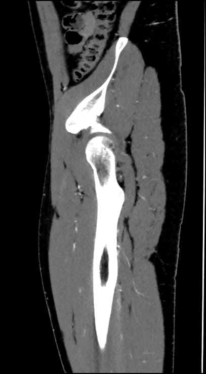 Normal pelvis CT angiogram (Radiopaedia 84966-100481 C 89).jpg