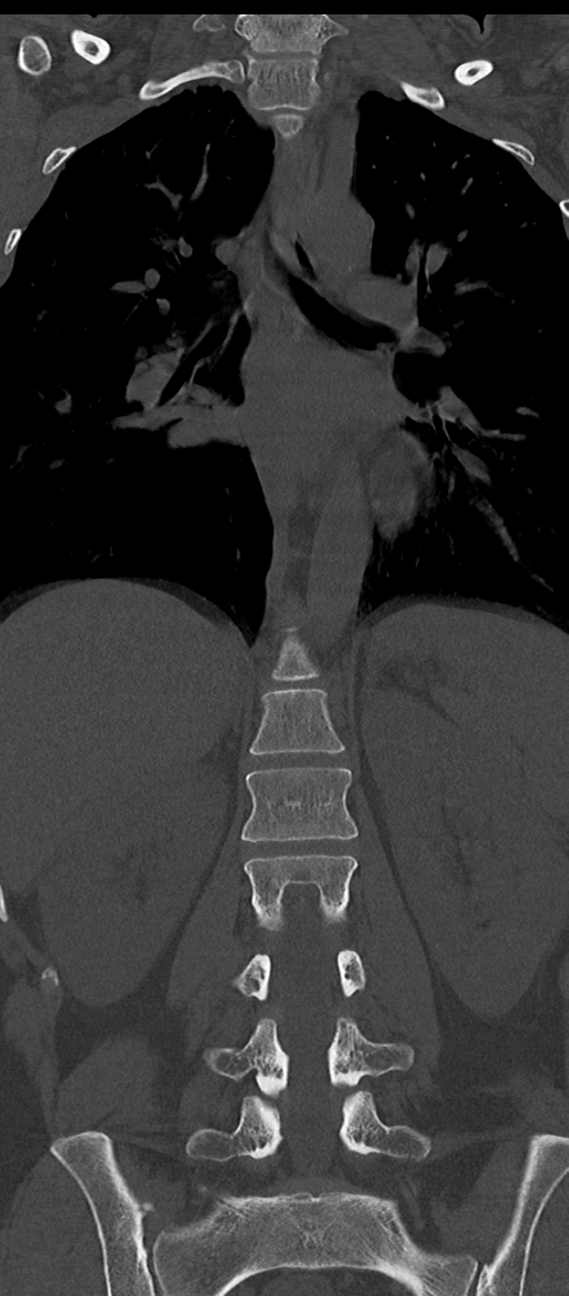 Normal thoracolumbar spine (Radiopaedia 43822-47309 Coronal bone window 45).png