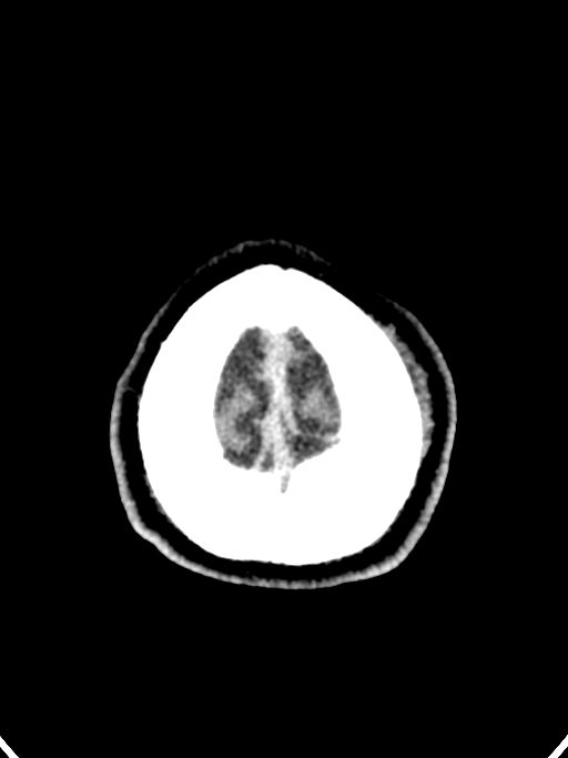 Normal trauma protocol brain and C-spine CT (Radiopaedia 83302-97709 Axial non-contrast 10).jpg